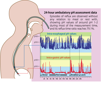 24-hour ambulatory pH assessment data.png